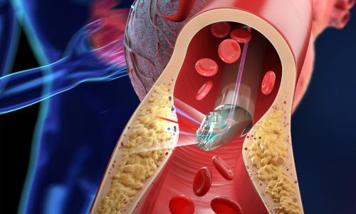 image of 3D-printed lens-in-lens design